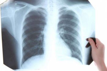 tuberculosis: sintomas, tratamiento y prevencion de una enfermedad que afecta a mas de 5 mil bonaerenses al ano