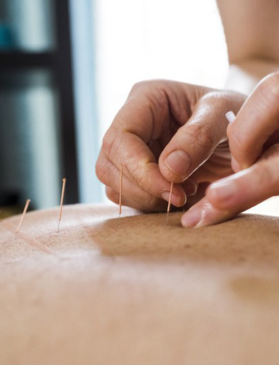 La acupuntura es una técnica milenaria de la medicina tradicional china que cada vez está más en tendencia y utilizan los kinesiólogos. 